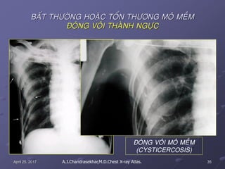 35April 25, 2017
BAÁT THÖÔØNG HOAËC TOÅN THÖÔNG MOÂ MEÀM
ÑOÙNG VOÂI THAØNH NGÖÏC
ÑOÙNG VOÂI MOÂ MEÀM
(CYSTICERCOSIS)
A.J.Chandrasekhar,M.D.Chest X-ray Atlas.
 