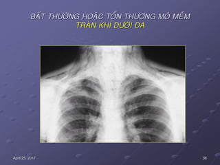 36April 25, 2017
BAÁT THÖÔØNG HOAËC TOÅN THÖÔNG MOÂ MEÀM
TRAØN KHÍ DÖÔÙI DA
 