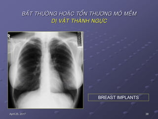 38April 25, 2017
BAÁT THÖÔØNG HOAËC TOÅN THÖÔNG MOÂ MEÀM
DÒ VAÄT THAØNH NGÖÏC
BREAST IMPLANTS
 