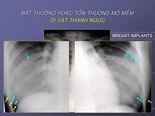 39April 25, 2017
BAÁT THÖÔØNG HOAËC TOÅN THÖÔNG MOÂ MEÀM
DÒ VAÄT THAØNH NGÖÏC
BREAST IMPLANTS
 