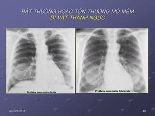 40April 25, 2017
BAÁT THÖÔØNG HOAËC TOÅN THÖÔNG MOÂ MEÀM
DÒ VAÄT THAØNH NGÖÏC
 