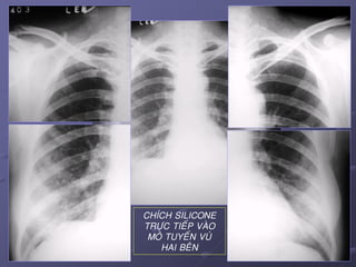 41April 25, 2017
CHÍCH SILICONE
TRÖÏC TIEÁP VAØO
MOÂ TUYEÁN VUÙ
HAI BEÂN
 