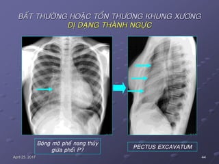 44April 25, 2017
BAÁT THÖÔØNG HOAËC TOÅN THÖÔNG KHUNG XÖÔNG
DÒ DAÏNG THAØNH NGÖÏC
Boùng môø pheá nang thuøy
giöõa phoåi P?
PECTUS EXCAVATUM
 