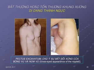 45April 25, 2017
BAÁT THÖÔØNG HOAËC TOÅN THÖÔNG KHUNG XÖÔNG
DÒ DAÏNG THAØNH NGÖÏC
PECTUS EXCAVATUM: CHUÙ YÙ SÖÏ BAÁT ÑOÁI XÖÙNG CUÛA
BOÙNG VUÙ VAØ NUÙM VUÙ (cross-eyed appearance of the nipples).
 