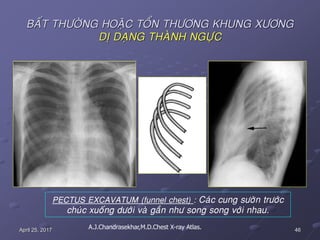 46April 25, 2017
BAÁT THÖÔØNG HOAËC TOÅN THÖÔNG KHUNG XÖÔNG
DÒ DAÏNG THAØNH NGÖÏC
PECTUS EXCAVATUM (funnel chest) : Caùc cung söôøn tröôùc
chuùc xuoáng döôùi vaø gaàn nhö song song vôùi nhau.
A.J.Chandrasekhar,M.D.Chest X-ray Atlas.
 