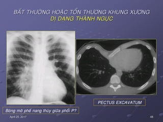 48April 25, 2017
BAÁT THÖÔØNG HOAËC TOÅN THÖÔNG KHUNG XÖÔNG
DÒ DAÏNG THAØNH NGÖÏC
Boùng môø pheá nang thuøy giöõa phoåi P?
PECTUS EXCAVATUM
 