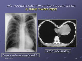 49April 25, 2017
BAÁT THÖÔØNG HOAËC TOÅN THÖÔNG KHUNG XÖÔNG
DÒ DAÏNG THAØNH NGÖÏC
Boùng môø pheá nang thuøy giöõa phoåi P?
PECTUS EXCAVATUM
 