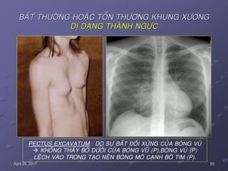 50April 25, 2017
BAÁT THÖÔØNG HOAËC TOÅN THÖÔNG KHUNG XÖÔNG
DÒ DAÏNG THAØNH NGÖÏC
PECTUS EXCAVATUM: DO SÖÏ BAÁT ÑOÁI XÖÙNG CUÛA BOÙNG VUÙ
 KHOÂNG THAÁY BÔØ DÖÔÙI CUÛA BOÙNG VUÙ (P),BOÙNG VUÙ (P)
LEÄCH VAØO TRONG TAÏO NEÂN BOÙNG MÔØ CAÏNH BÔØ TIM (P).
 