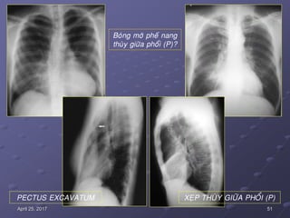 51April 25, 2017
PECTUS EXCAVATUM XEÏP THUØY GIÖÕA PHOÅI (P)
Boùng môø pheá nang
thuøy giöõa phoåi (P)?
 
