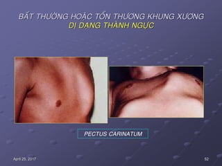 52April 25, 2017
BAÁT THÖÔØNG HOAËC TOÅN THÖÔNG KHUNG XÖÔNG
DÒ DAÏNG THAØNH NGÖÏC
PECTUS CARINATUM
 