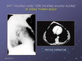 54April 25, 2017
BAÁT THÖÔØNG HOAËC TOÅN THÖÔNG KHUNG XÖÔNG
DÒ DAÏNG THAØNH NGÖÏC
PECTUS CARINATUM
 