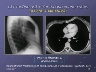 55April 25, 2017
BAÁT THÖÔØNG HOAËC TOÅN THÖÔNG KHUNG XÖÔNG
DÒ DAÏNG THAØNH NGÖÏC
PECTUS CARINATUM
(Pigeon breast)
Imaging of Chest Wall Disorders.Mi-Young Jeung, MD. (Radiographics. 1999;19:617-637.)
 
