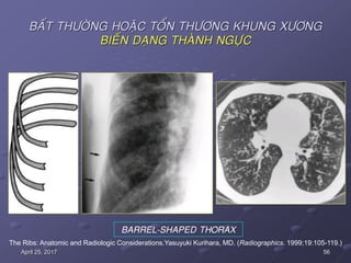 56April 25, 2017
BAÁT THÖÔØNG HOAËC TOÅN THÖÔNG KHUNG XÖÔNG
BIEÁN DAÏNG THAØNH NGÖÏC
BARREL-SHAPED THORAX
The Ribs: Anatomic and Radiologic Considerations.Yasuyuki Kurihara, MD. (Radiographics. 1999;19:105-119.)
 