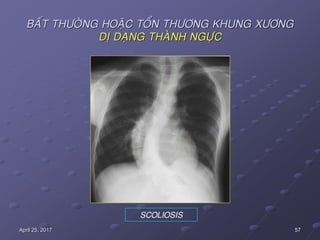 57April 25, 2017
BAÁT THÖÔØNG HOAËC TOÅN THÖÔNG KHUNG XÖÔNG
DÒ DAÏNG THAØNH NGÖÏC
SCOLIOSIS
 