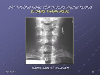 60April 25, 2017
BAÁT THÖÔØNG HOAËC TOÅN THÖÔNG KHUNG XÖÔNG
DÒ DAÏNG THAØNH NGÖÏC
XÖÔNG SÖÔØN COÅ VII HAI BEÂN
 