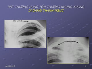 61April 25, 2017
BAÁT THÖÔØNG HOAËC TOÅN THÖÔNG KHUNG XÖÔNG
DÒ DAÏNG THAØNH NGÖÏC
 