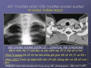 62April 25, 2017
BAÁT THÖÔØNG HOAËC TOÅN THÖÔNG KHUNG XÖÔNG
DÒ DAÏNG THAØNH NGÖÏC
HOÄI CHÖÙNG XÖÔNG SÖÔØN COÅ – CERVICAL RIB SYNDROME:
Beänh nhaân Nöõ,17 tuoåi,ñau vaø yeáu caùnh tay (P) ôû moät soá tö theá.
-Phim X quang:XS coå VII hai beân,khôùp giaû giöõa XS coå VII (T) vaø XS I.
-Phim CECT:Cheøn eùp ÑgM döôùi ñoøn (P) bôûi xöông ñoøn vaø XS coå (muõi
teân)
Imaging of Chest Wall Disorders.Mi-Young Jeung, MD. (Radiographics. 1999;19:617-637.)
 