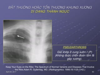 63April 25, 2017
BAÁT THÖÔØNG HOAËC TOÅN THÖÔNG KHUNG XÖÔNG
DÒ DAÏNG THAØNH NGÖÏC
PSEUDARTHROSIS
Giaû khôùp ôû cung söôøn I (P)
(khoâng ñöôïc chaån ñoaùn laàm laø
gaõy xöông).
Keep Your Eyes on the Ribs: The Spectrum of Normal Variants and Diseases That Involve
the Ribs.Adam R. Guttentag, MD. (Radiographics. 1999;19:1125-1142.)
 