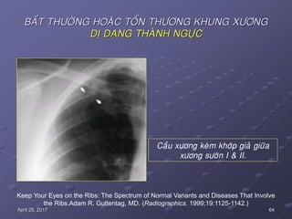64April 25, 2017
BAÁT THÖÔØNG HOAËC TOÅN THÖÔNG KHUNG XÖÔNG
DÒ DAÏNG THAØNH NGÖÏC
Keep Your Eyes on the Ribs: The Spectrum of Normal Variants and Diseases That Involve
the Ribs.Adam R. Guttentag, MD. (Radiographics. 1999;19:1125-1142.)
Caàu xöông keøm khôùp giaû giöõa
xöông söôøn I & II.
 