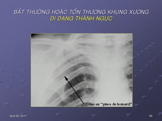 65April 25, 2017
BAÁT THÖÔØNG HOAËC TOÅN THÖÔNG KHUNG XÖÔNG
DÒ DAÏNG THAØNH NGÖÏC
 