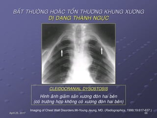 66April 25, 2017
BAÁT THÖÔØNG HOAËC TOÅN THÖÔNG KHUNG XÖÔNG
DÒ DAÏNG THAØNH NGÖÏC
Imaging of Chest Wall Disorders.Mi-Young Jeung, MD. (Radiographics. 1999;19:617-637.)
CLEIDOCRANIAL DYSOSTOSIS
Hình aûnh giaûm saûn xöông ñoøn hai beân
(coù tröôøng hôïp khoâng coù xöông ñoøn hai beân)
 