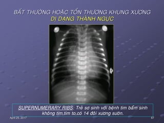 67April 25, 2017
BAÁT THÖÔØNG HOAËC TOÅN THÖÔNG KHUNG XÖÔNG
DÒ DAÏNG THAØNH NGÖÏC
SUPERNUMERARY RIBS: Treû sô sinh vôùi beänh tim baåm sinh
khoâng tím,tim to,coù 14 ñoâi xöông söôøn.
 
