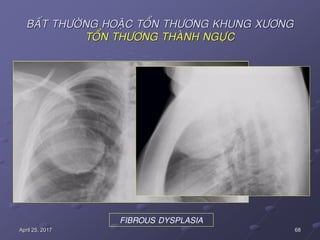 68April 25, 2017
BAÁT THÖÔØNG HOAËC TOÅN THÖÔNG KHUNG XÖÔNG
TOÅN THÖÔNG THAØNH NGÖÏC
FIBROUS DYSPLASIA
 