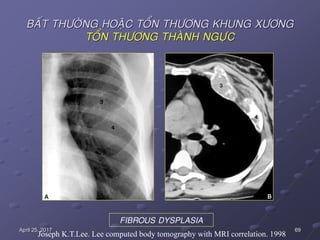 69April 25, 2017
BAÁT THÖÔØNG HOAËC TOÅN THÖÔNG KHUNG XÖÔNG
TOÅN THÖÔNG THAØNH NGÖÏC
FIBROUS DYSPLASIA
Joseph K.T.Lee. Lee computed body tomography with MRI correlation. 1998
 