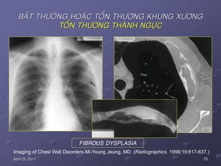 70April 25, 2017
BAÁT THÖÔØNG HOAËC TOÅN THÖÔNG KHUNG XÖÔNG
TOÅN THÖÔNG THAØNH NGÖÏC
Imaging of Chest Wall Disorders.Mi-Young Jeung, MD. (Radiographics. 1999;19:617-637.)
FIBROUS DYSPLASIA
 