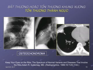 72April 25, 2017
BAÁT THÖÔØNG HOAËC TOÅN THÖÔNG KHUNG XÖÔNG
TOÅN THÖÔNG THAØNH NGÖÏC
Keep Your Eyes on the Ribs: The Spectrum of Normal Variants and Diseases That Involve
the Ribs.Adam R. Guttentag, MD. (Radiographics. 1999;19:1125-1142.)
OSTEOCHONDROMA
 