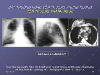 74April 25, 2017
BAÁT THÖÔØNG HOAËC TOÅN THÖÔNG KHUNG XÖÔNG
TOÅN THÖÔNG THAØNH NGÖÏC
Keep Your Eyes on the Ribs: The Spectrum of Normal Variants and Diseases That Involve
the Ribs.Adam R. Guttentag, MD. (Radiographics. 1999;19:1125-1142.)
CHONDROSARCOMA
 