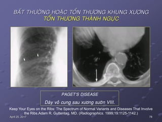 78April 25, 2017
BAÁT THÖÔØNG HOAËC TOÅN THÖÔNG KHUNG XÖÔNG
TOÅN THÖÔNG THAØNH NGÖÏC
Keep Your Eyes on the Ribs: The Spectrum of Normal Variants and Diseases That Involve
the Ribs.Adam R. Guttentag, MD. (Radiographics. 1999;19:1125-1142.)
PAGET’S DISEASE
Daøy voû cung sau xöông söôøn VIII.
 