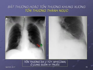 79April 25, 2017
BAÁT THÖÔØNG HOAËC TOÅN THÖÔNG KHUNG XÖÔNG
TOÅN THÖÔNG THAØNH NGÖÏC
TOÅN THÖÔNG ÑA U TUÛY (MYELOMA)
ÔÛ CUNG SÖÔØN VI TRÖÔÙC
 