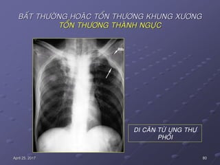 80April 25, 2017
BAÁT THÖÔØNG HOAËC TOÅN THÖÔNG KHUNG XÖÔNG
TOÅN THÖÔNG THAØNH NGÖÏC
DI CAÊN TÖØ UNG THÖ
PHOÅI
 