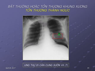 81April 25, 2017
UNG THÖ DI CAÊN CUNG SÖÔØN VII (T)
BAÁT THÖÔØNG HOAËC TOÅN THÖÔNG KHUNG XÖÔNG
TOÅN THÖÔNG THAØNH NGÖÏC
 