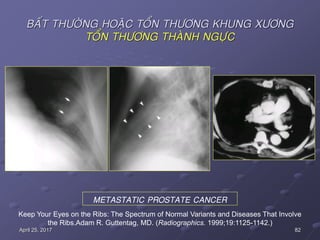 82April 25, 2017
BAÁT THÖÔØNG HOAËC TOÅN THÖÔNG KHUNG XÖÔNG
TOÅN THÖÔNG THAØNH NGÖÏC
Keep Your Eyes on the Ribs: The Spectrum of Normal Variants and Diseases That Involve
the Ribs.Adam R. Guttentag, MD. (Radiographics. 1999;19:1125-1142.)
METASTATIC PROSTATE CANCER
 