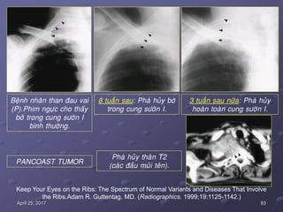 83April 25, 2017
Keep Your Eyes on the Ribs: The Spectrum of Normal Variants and Diseases That Involve
the Ribs.Adam R. Guttentag, MD. (Radiographics. 1999;19:1125-1142.)
PANCOAST TUMOR
Beänh nhaân than ñau vai
(P).Phim ngöïc cho thaáy
bôø trong cung söôøn I
bình thöôøng.
8 tuaàn sau: Phaù huûy bôø
trong cung söôøn I.
3 tuaàn sau nöõa: Phaù huûy
hoaøn toaøn cung söôøn I.
Phaù huûy thaân T2
(caùc ñaàu muõi teân).
 