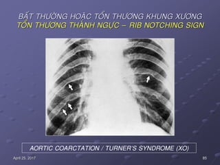 85April 25, 2017
BAÁT THÖÔØNG HOAËC TOÅN THÖÔNG KHUNG XÖÔNG
TOÅN THÖÔNG THAØNH NGÖÏC – RIB NOTCHING SIGN
AORTIC COARCTATION / TURNER’S SYNDROME (XO)
 