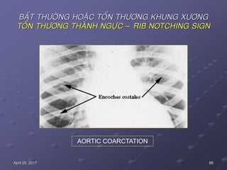 86April 25, 2017
BAÁT THÖÔØNG HOAËC TOÅN THÖÔNG KHUNG XÖÔNG
TOÅN THÖÔNG THAØNH NGÖÏC – RIB NOTCHING SIGN
AORTIC COARCTATION
 