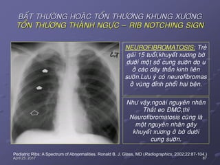 87April 25, 2017
BAÁT THÖÔØNG HOAËC TOÅN THÖÔNG KHUNG XÖÔNG
TOÅN THÖÔNG THAØNH NGÖÏC – RIB NOTCHING SIGN
Pediatric Ribs: A Spectrum of Abnormalities. Ronald B. J. Glass, MD (Radiographics. 2002;22:87-104.)
NEUROFIBROMATOSIS: Treû
gaùi 15 tuoåi,khuyeát xöông bôø
döôùi moät soá cung söôøn do u
ôû caùc daây thaàn kinh lieân
söôøn.Löu yù coù neurofibromas
ôû vuøng ñænh phoåi hai beân.
Nhö vaäy,ngoaøi nguyeân nhaân
Thaét eo ÑMC,thì
Neurofibromatosis cuõng laø
moät nguyeân nhaân gaây
khuyeát xöông ôû bôø döôùi
cung söôøn.
 