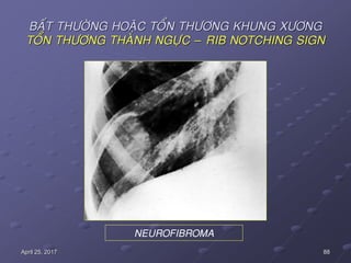 88April 25, 2017
BAÁT THÖÔØNG HOAËC TOÅN THÖÔNG KHUNG XÖÔNG
TOÅN THÖÔNG THAØNH NGÖÏC – RIB NOTCHING SIGN
NEUROFIBROMA
 