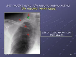 89April 25, 2017
BAÁT THÖÔØNG HOAËC TOÅN THÖÔNG KHUNG XÖÔNG
TOÅN THÖÔNG THAØNH NGÖÏC
GAÕY CAÙC CUNG XÖÔNG SÖÔØN
TREÂN BEÂN (P)
 