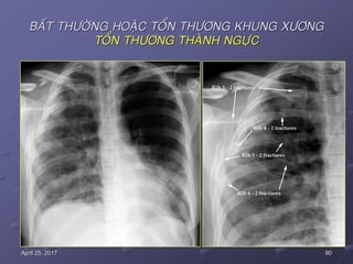 90April 25, 2017
BAÁT THÖÔØNG HOAËC TOÅN THÖÔNG KHUNG XÖÔNG
TOÅN THÖÔNG THAØNH NGÖÏC
 