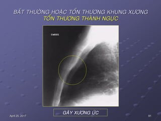 91April 25, 2017
BAÁT THÖÔØNG HOAËC TOÅN THÖÔNG KHUNG XÖÔNG
TOÅN THÖÔNG THAØNH NGÖÏC
GAÕY XÖÔNG ÖÙC
 