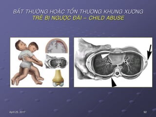 92April 25, 2017
BAÁT THÖÔØNG HOAËC TOÅN THÖÔNG KHUNG XÖÔNG
TREÛ BÒ NGÖÔÏC ÑAÕI – CHILD ABUSE
 