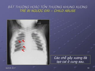 93April 25, 2017
BAÁT THÖÔØNG HOAËC TOÅN THÖÔNG KHUNG XÖÔNG
TREÛ BÒ NGÖÔÏC ÑAÕI – CHILD ABUSE
Caùc choã gaãy xöông ñaõ
taïo cal ôû cung sau.
 
