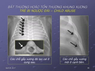 95April 25, 2017
BAÁT THÖÔØNG HOAËC TOÅN THÖÔNG KHUNG XÖÔNG
TREÛ BÒ NGÖÔÏC ÑAÕI – CHILD ABUSE
Caùc choã gaãy xöông ñaõ taïo cal ôû
cung sau.
Caùc choã gaãy xöông
môùi ôû caïnh beân.
 