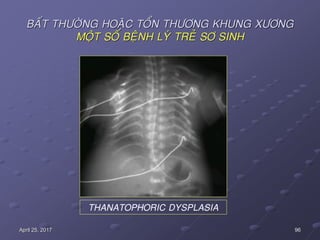 96April 25, 2017
BAÁT THÖÔØNG HOAËC TOÅN THÖÔNG KHUNG XÖÔNG
MOÄT SOÁ BEÄNH LYÙ TREÛ SÔ SINH
THANATOPHORIC DYSPLASIA
 