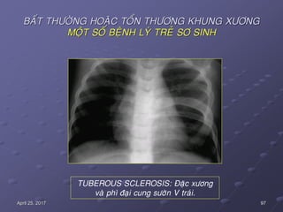 97April 25, 2017
BAÁT THÖÔØNG HOAËC TOÅN THÖÔNG KHUNG XÖÔNG
MOÄT SOÁ BEÄNH LYÙ TREÛ SÔ SINH
TUBEROUS SCLEROSIS: Ñaëc xöông
vaø phì ñaïi cung söôøn V traùi.
 