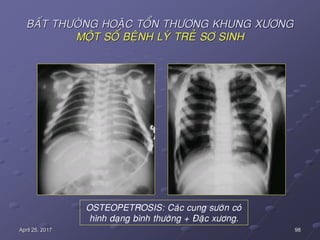 98April 25, 2017
BAÁT THÖÔØNG HOAËC TOÅN THÖÔNG KHUNG XÖÔNG
MOÄT SOÁ BEÄNH LYÙ TREÛ SÔ SINH
OSTEOPETROSIS: Caùc cung söôøn coù
hình daïng bình thöôøng + Ñaëc xöông.
 
